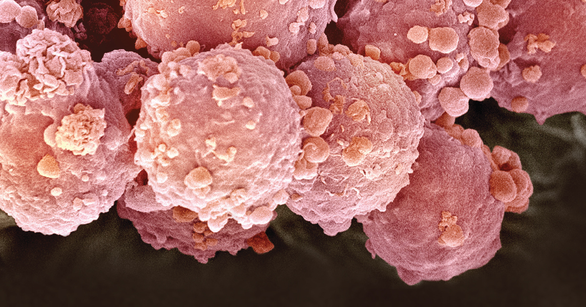 TherapyRelated Late Adverse Events in Hodgkin’s Lymphoma